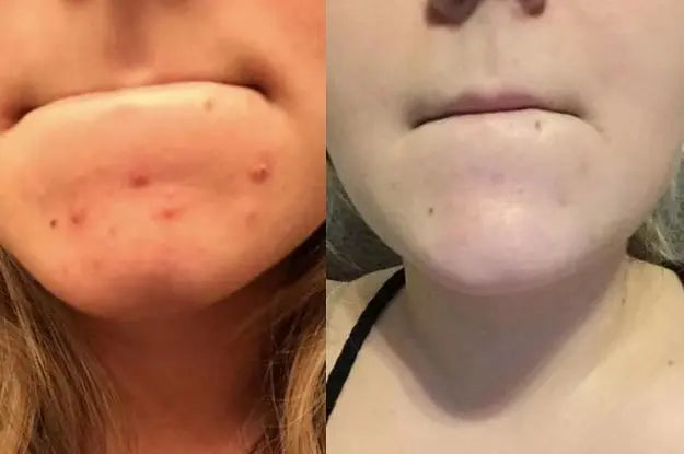 A before-and-after image showing the improvement of acne on a person's chin. The left side displays the chin with several acne spots, while the right side shows significantly clearer skin.